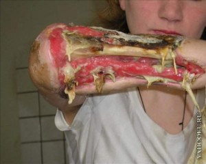 Krokodil pictures reveal a horror show